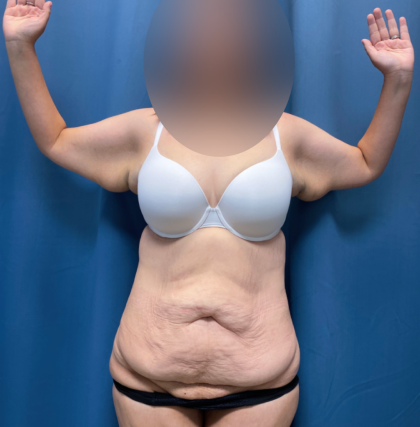 Tummy Tuck Before & After Patient #13485