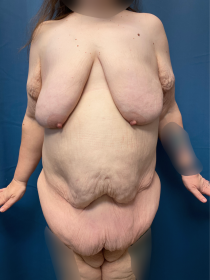 Massive Weight Loss Before & After Patient #13508