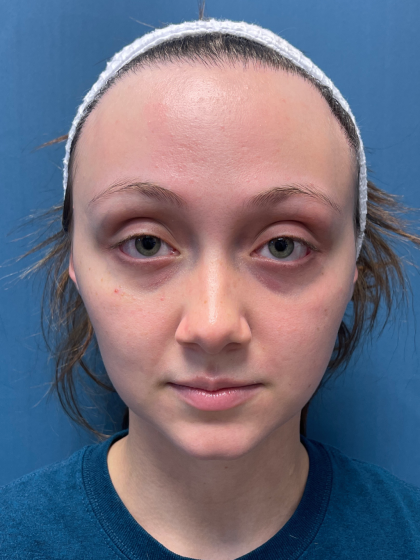 Forehead Reduction Before & After Patient #12935