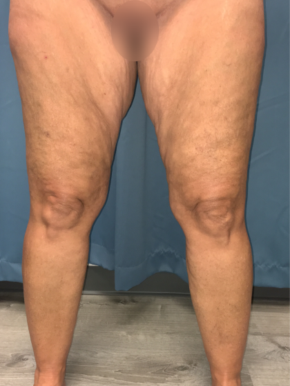 Thigh Lift Before & After Patient #13528