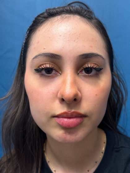 Forehead Reduction Before & After Patient #12936