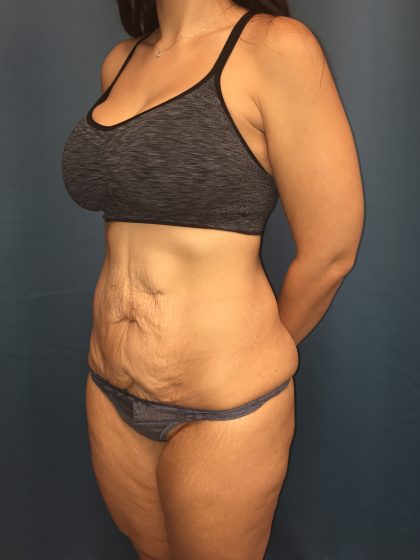 Tummy Tuck Before & After Patient #13016