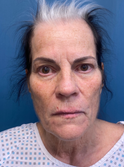 Facelift and Necklift Before & After Patient #12890