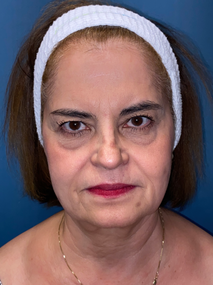 Forehead Reduction Before & After Patient #12937