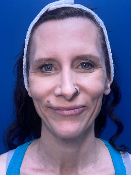 Forehead Reduction Before & After Patient #12940