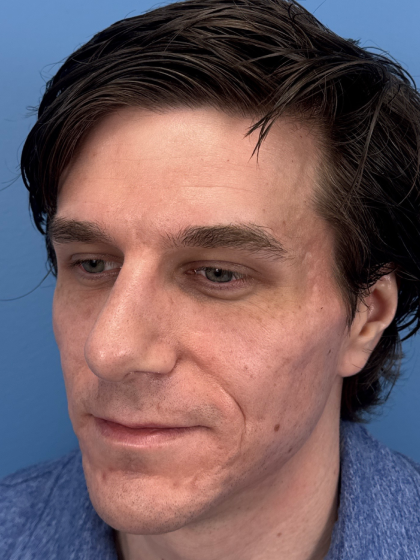 Rhinoplasty Before & After Patient #12901