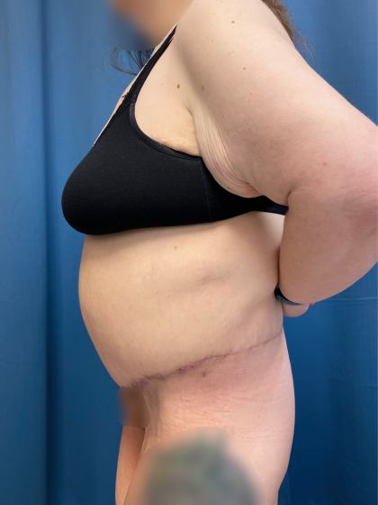 Lower Body Lift Before & After Patient #13501