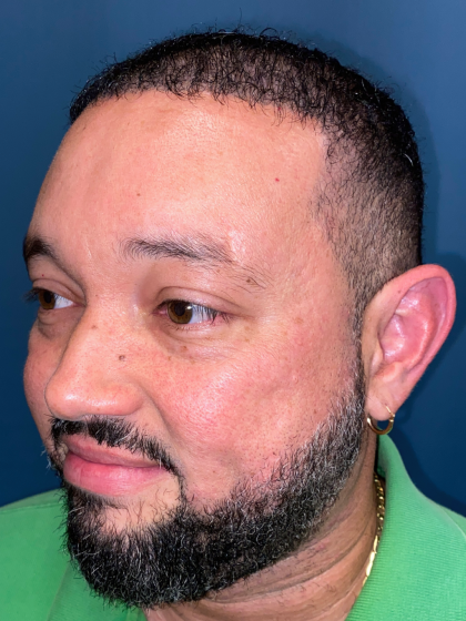 NeoGraft Before & After Patient #12914