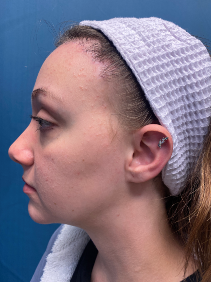Forehead Reduction Before & After Patient #12935