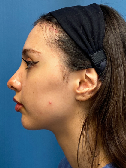 Forehead Reduction Before & After Patient #12936