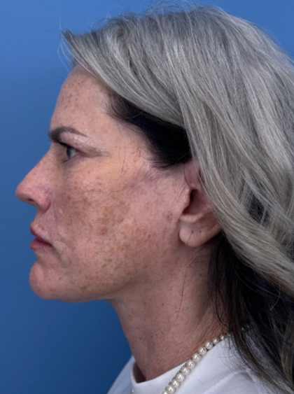 Facelift and Necklift Before & After Patient #12890