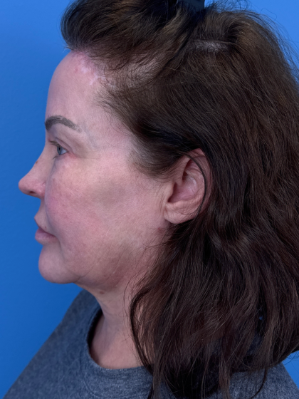 Forehead Reduction Before & After Patient #12938
