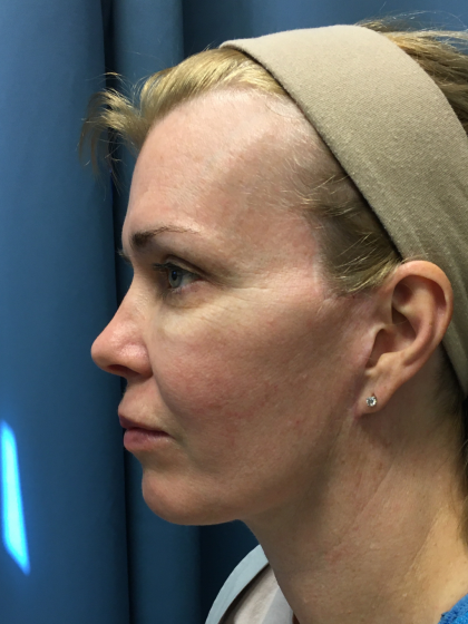 Facelift and Necklift Before & After Patient #13012