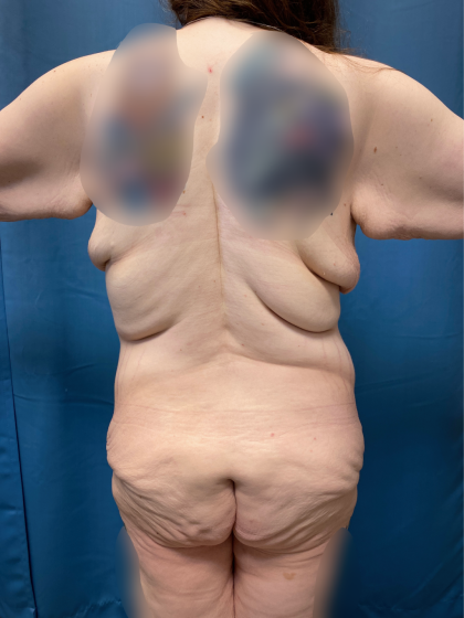 Massive Weight Loss Before & After Patient #13508