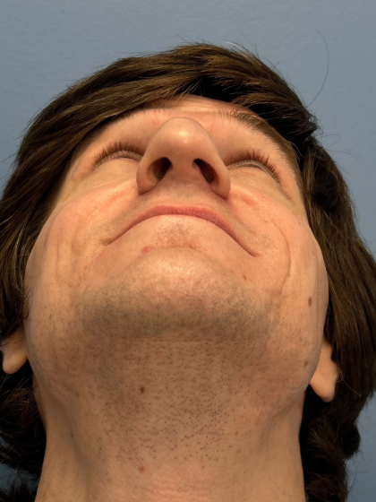 Rhinoplasty Before & After Patient #12901