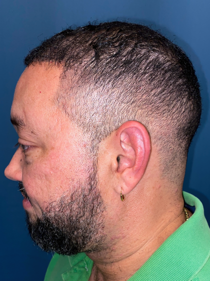 NeoGraft Before & After Patient #12914