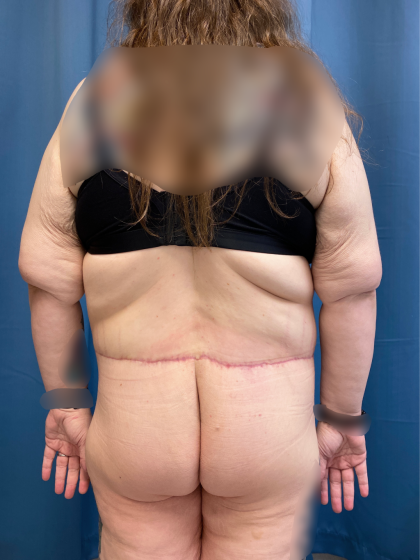 Massive Weight Loss Before & After Patient #13508