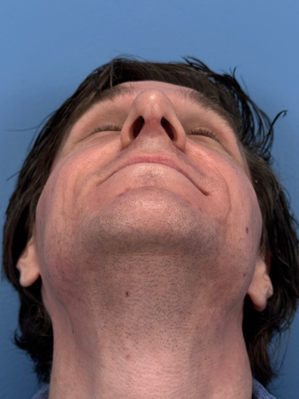 Rhinoplasty Before & After Patient #12901