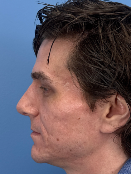 Rhinoplasty Before & After Patient #12901