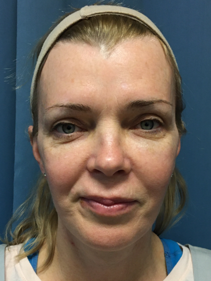 Facelift and Necklift Before & After Patient #13012