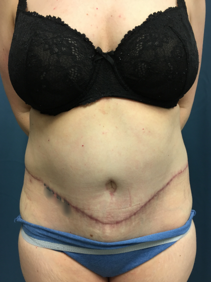 Tummy Tuck Before & After Patient #13015