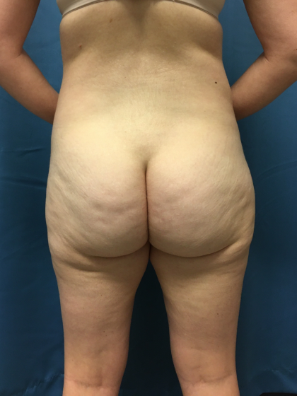 Liposuction Before & After Patient #13017