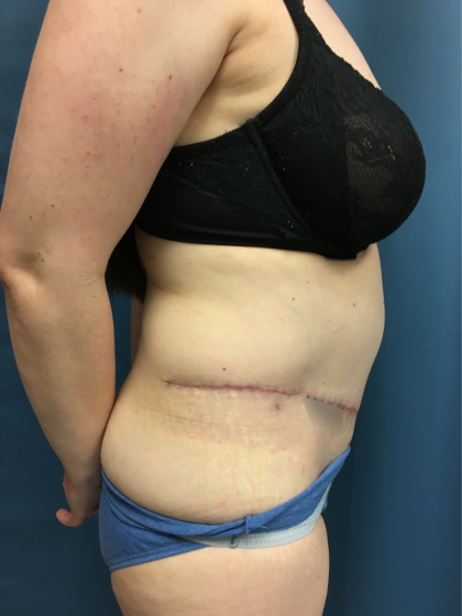 Tummy Tuck Before & After Patient #13015