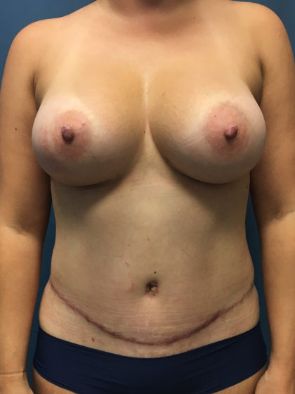 Mommy Makeover Before & After Patient #13014