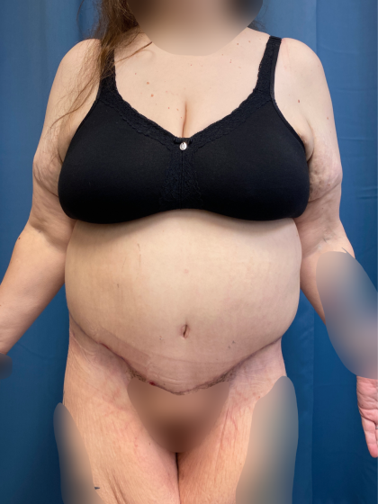 Massive Weight Loss Before & After Patient #13508
