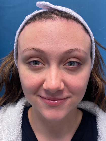 Forehead Reduction Before & After Patient #12935