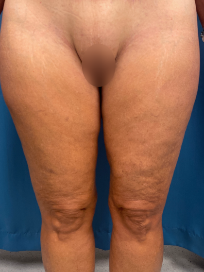 Thigh Lift Before & After Patient #13528