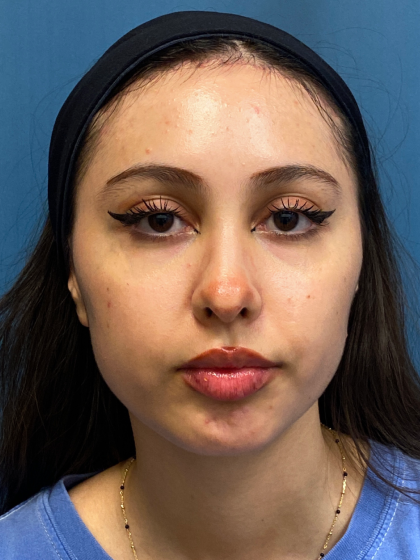 Forehead Reduction Before & After Patient #12936