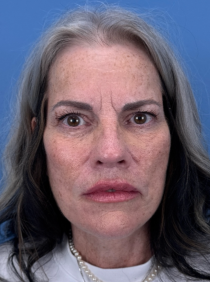 Facelift and Necklift Before & After Patient #12890