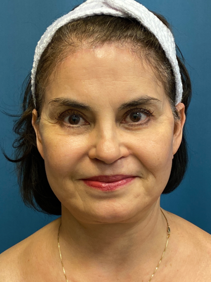 Forehead Reduction Before & After Patient #12937