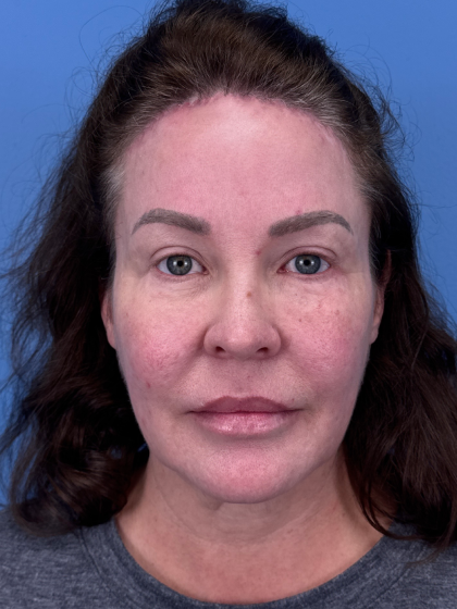 Forehead Reduction Before & After Patient #12938