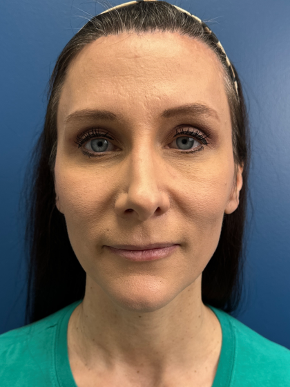 Forehead Reduction Before & After Patient #12940