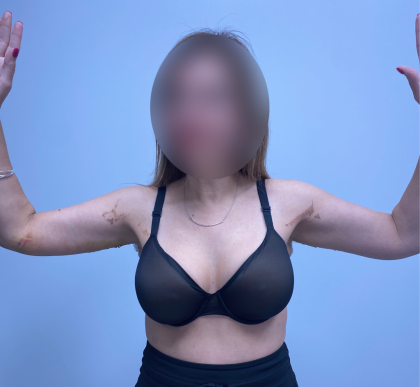 Arm Lift Before & After Patient #12946