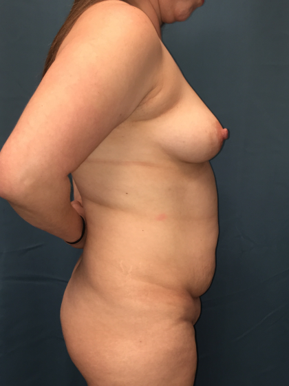 Mommy Makeover Before & After Patient #13014
