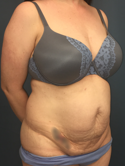 Tummy Tuck Before & After Patient #13015