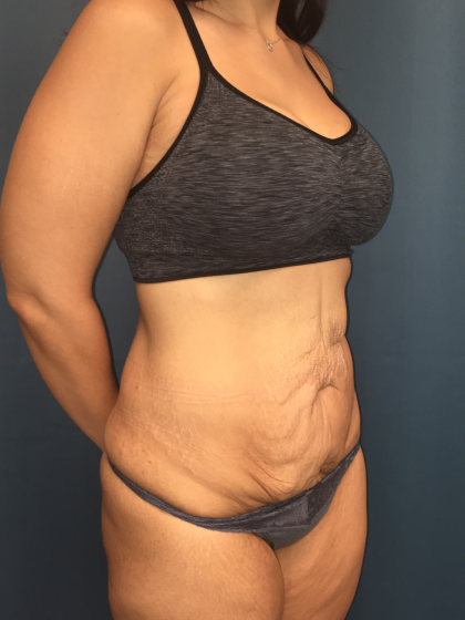 Tummy Tuck Before & After Patient #13016