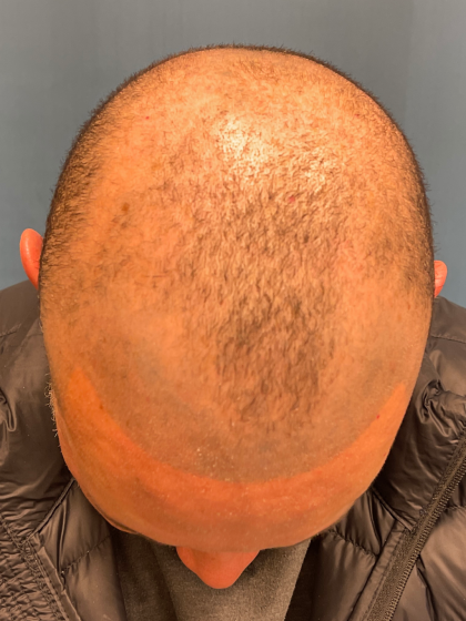NeoGraft Before & After Patient #12914