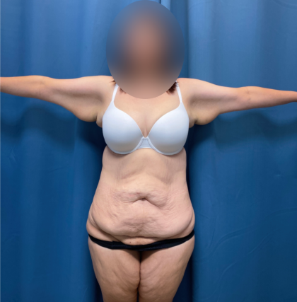 Tummy Tuck Before & After Patient #13485