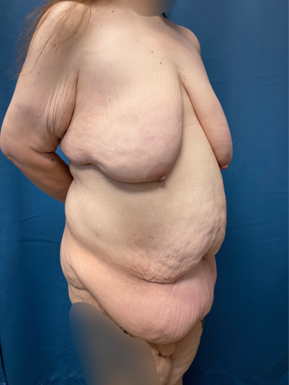 Massive Weight Loss Before & After Patient #13508