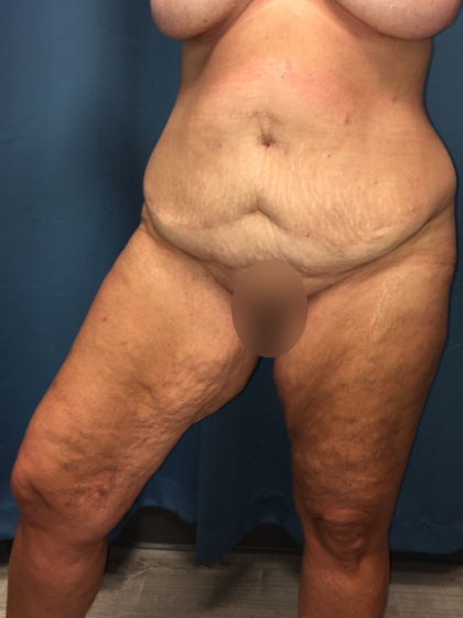 Thigh Lift Before & After Patient #13528