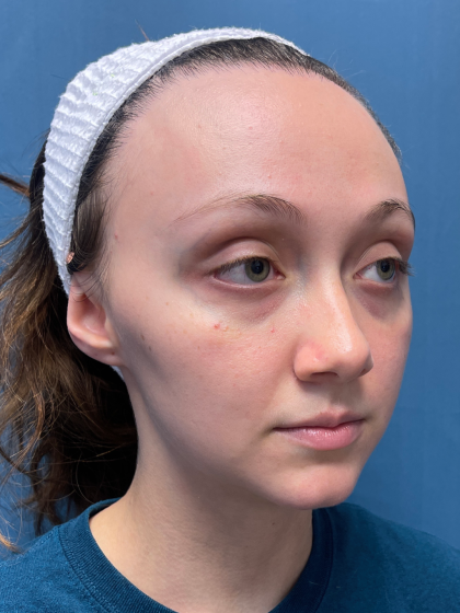 Forehead Reduction Before & After Patient #12935