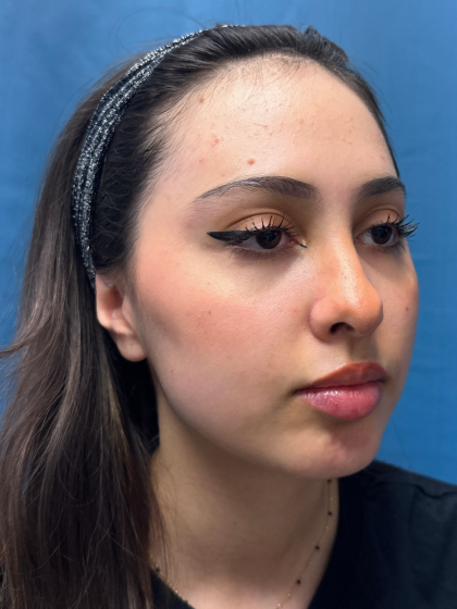 Forehead Reduction Before & After Patient #12936