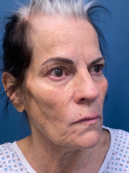 Facelift and Necklift Before & After Patient #12890