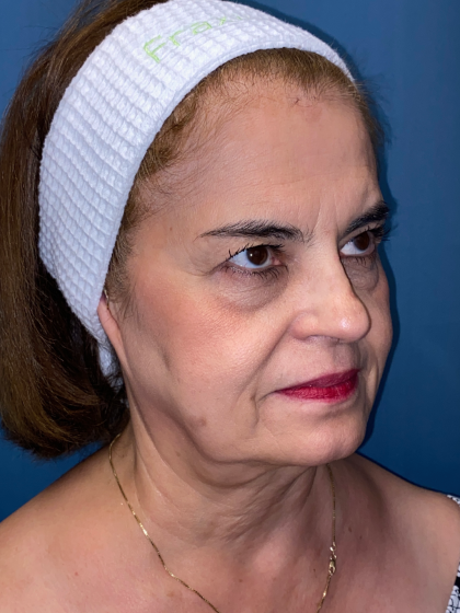 Forehead Reduction Before & After Patient #12937