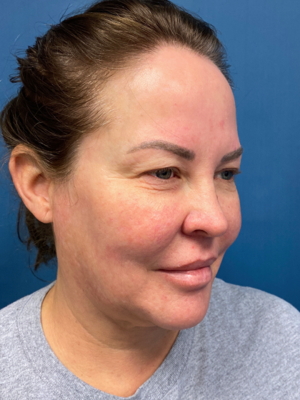 Forehead Reduction Before & After Patient #12938