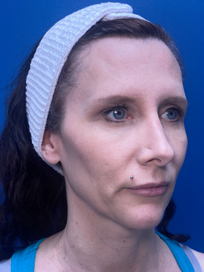 Forehead Reduction Before & After Patient #12940